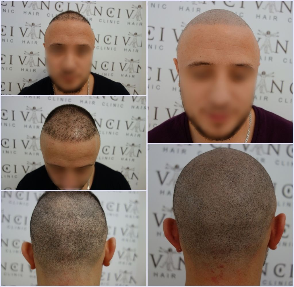before-after-hairtransplant-repair-msp-vinci-berlin_zps3itkt1qi.jpg