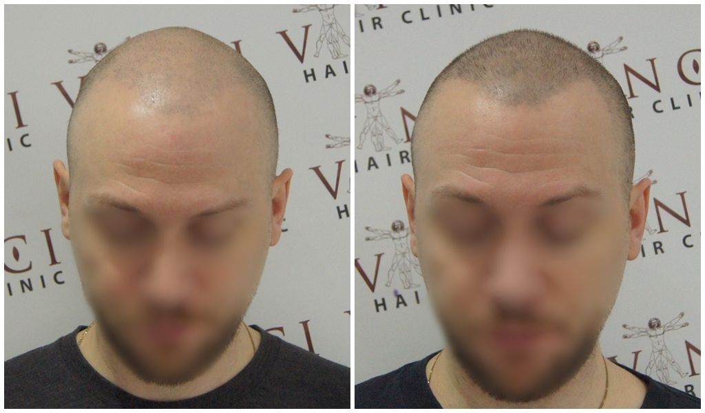 face-ht-repair-msp-vinci-hair-clinic_zps9dp0il1o.jpg