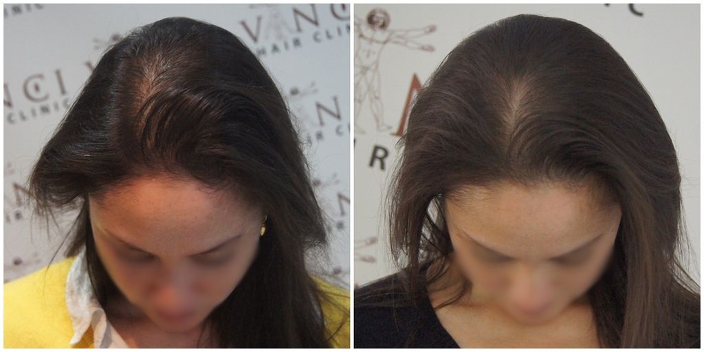 before-after-msp-female-vinci-hair-clinic_zpsvalr0gff.jpg