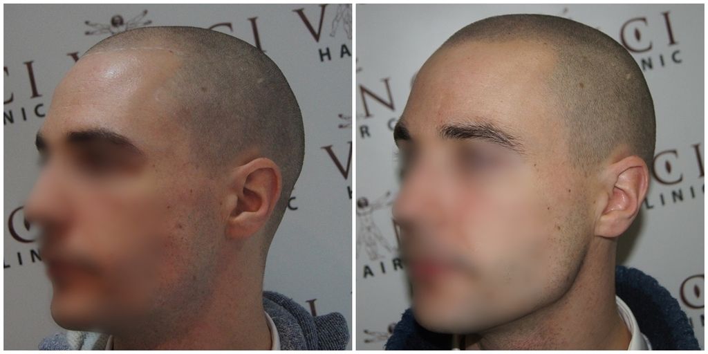 before-after-msp-vinci-hair-clinic-left_zpskibqivqh.jpg