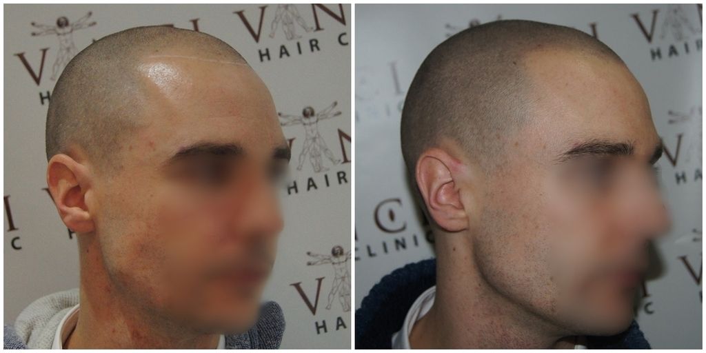before-after-msp-vinci-hair-clinic-right_zpsmmfywbk3.jpg
