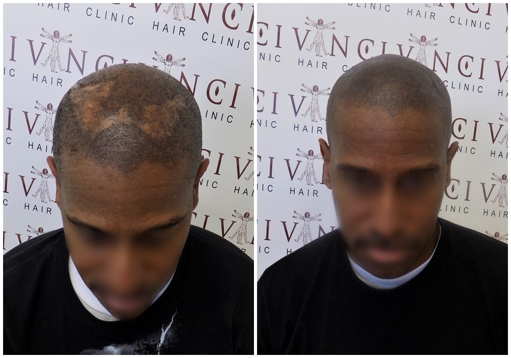 before-after-msp-vinci-hair-clinic.1_zpse6jdkycu.jpg