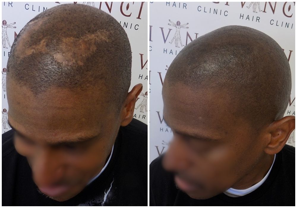 before-after-msp-vinci-hair-clinic.2_zpsdcfsuydx.jpg