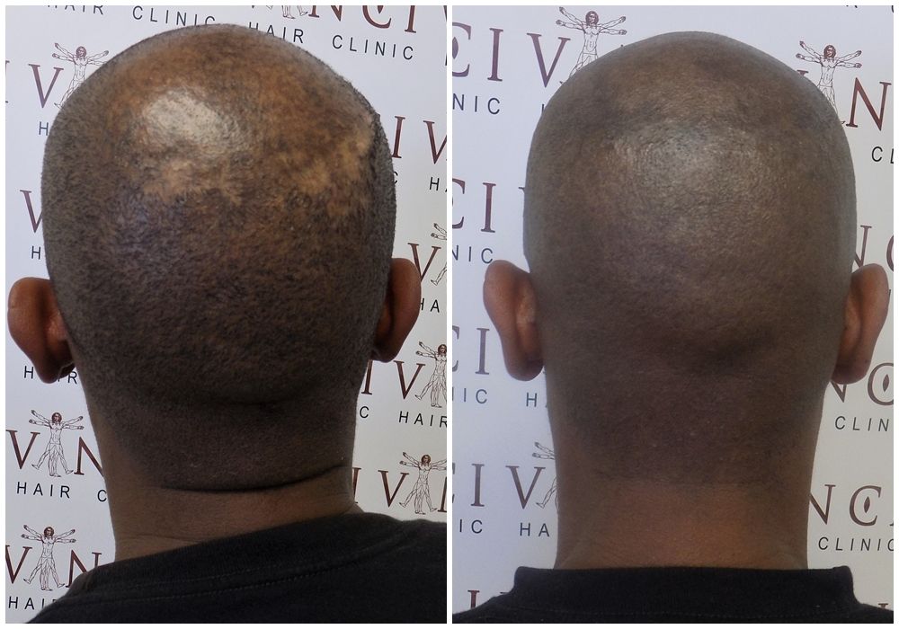 before-after-msp-vinci-hair-clinic.3_zpsoroc4aym.jpg