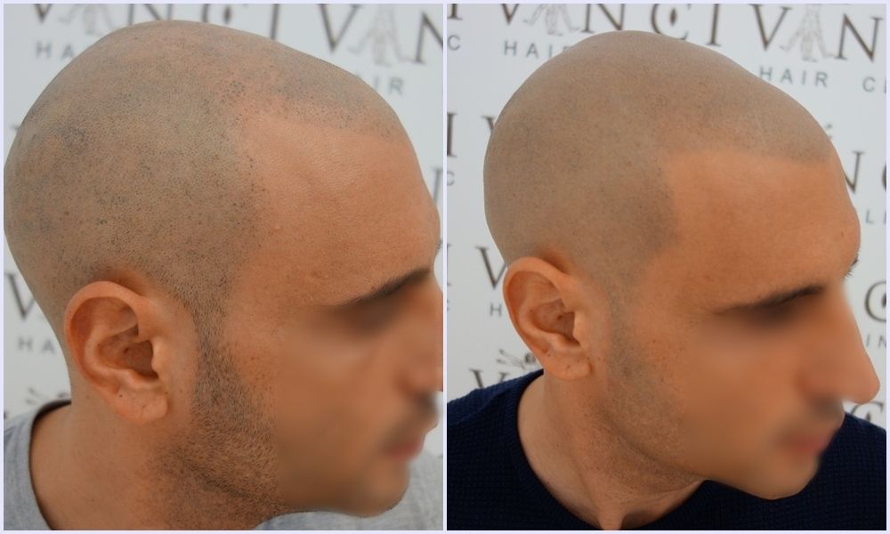 before-after-msp-vinci-hair-clinic_zpspf9yodyi.jpg