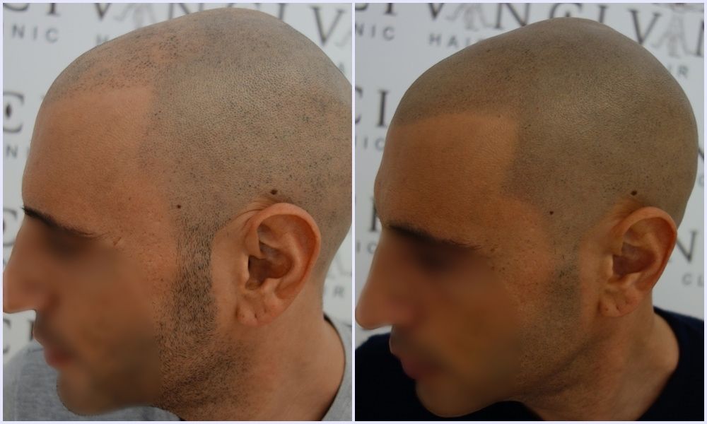 before-after-msp.-vinci-hair-clinic._zpsdsayhfqw.jpg