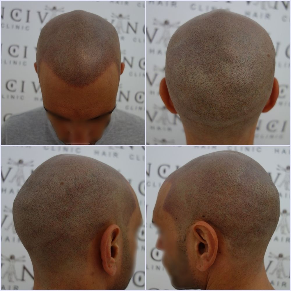 first-msp-repair-session-vinci-hair-clinic_zpsxcr9ksj8.jpg
