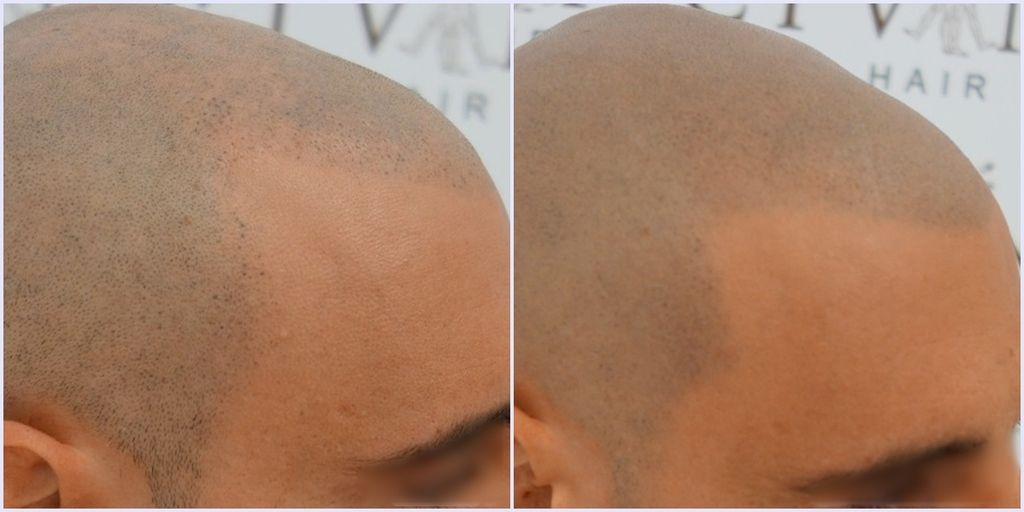 repair-hairline-close-vinci-hair-clinic-msp_zpsvchgcnzg.jpg