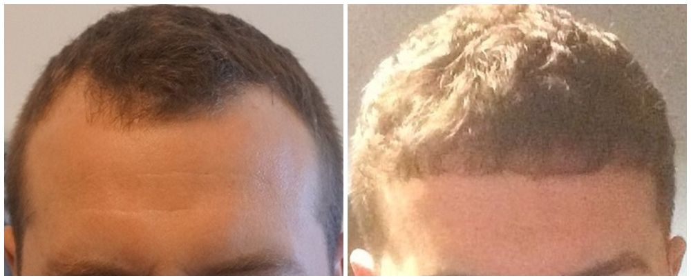 before-7-months-post-op-vinci-hair-clinic_zpsl9uodnol.jpg